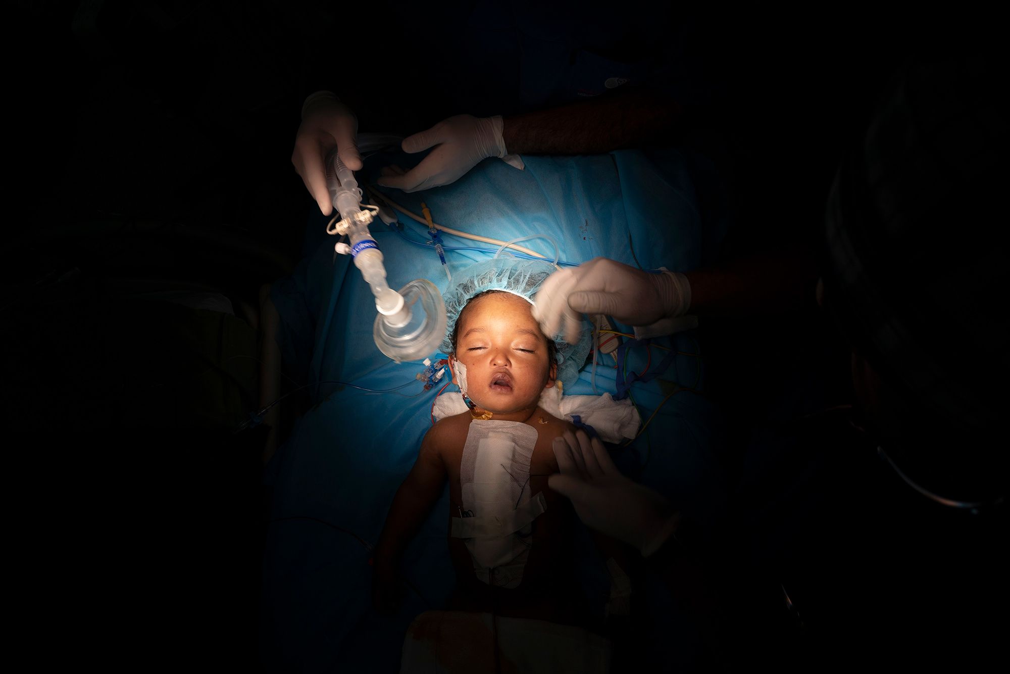 One-year-old Yazan has his oxygen mask removed after heart surgery at the Tajoura National Heart Center in Tripoli, Libya, on Feb. 27.
